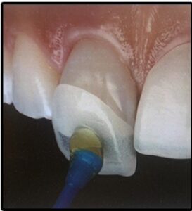Faccette Dentali No Prep